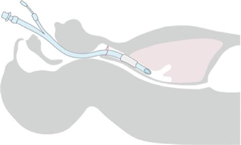 cuff leak test|Cuff Leak Test — UH Anesthesiology